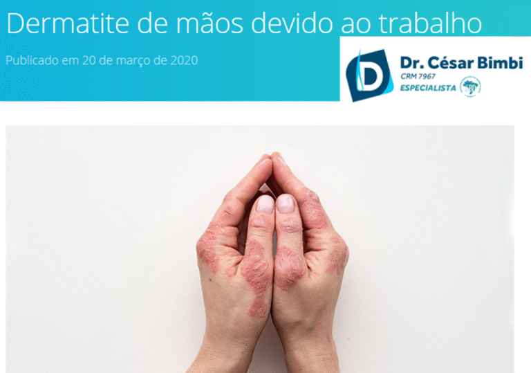 Artigo: Dermatite de mãos devido ao trabalho – Dr. César Bimbi